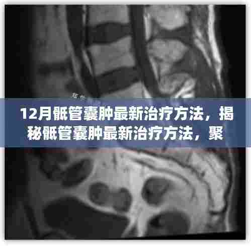 揭秘骶管囊肿最新治疗方法,聚焦十二月医学进展,为患者带来福音